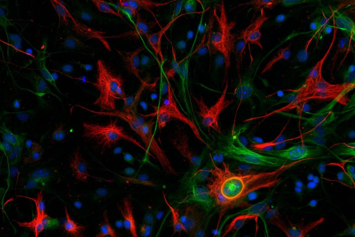 Glioblastoma mesenquimal de ratón con las células madre marcadas en color verde y las células diferenciadas en rojo. Foto: CNIO.